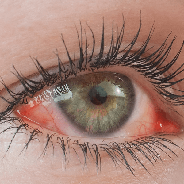 Objaw alergii: swedzenie i lzawienie oczu